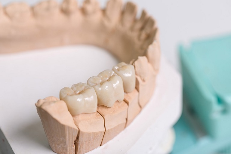Thời gian trồng răng cấm mất bao lâu sẽ tùy thuộc vào từng phương pháp