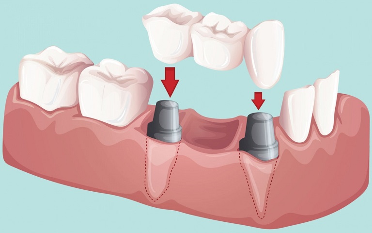 Màu sắc, hình dáng của cầu răng sứ thường tương đồng với răng thật