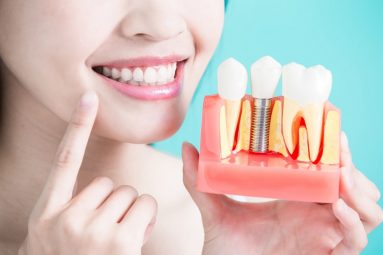 Răng Implant có đủ chân răng, thân răng nên giúp ngăn chặn hiện tượng tiêu xương