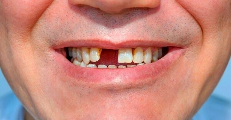 Trồng răng cửa hết bao nhiêu tiền cũng sẽ tùy thuộc vào số lượng răng cửa cần trồng