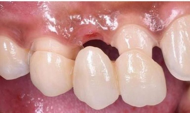 Cầu răng sứ có tính thẩm mỹ cao hơn so với hàm giả tháo lắp