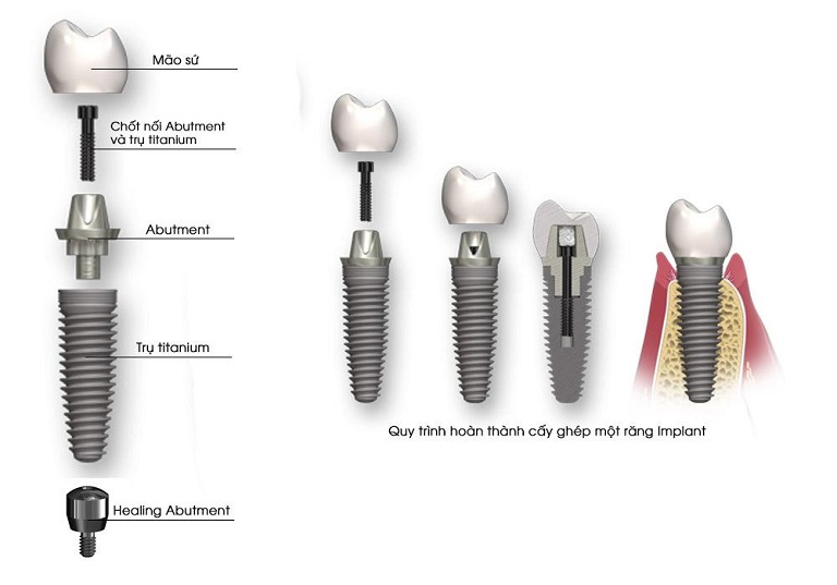 Răng giả vĩnh viễn được cấu tạo gồm 3 bộ phận chính là trụ Implant, Abutment và mão răng sứ