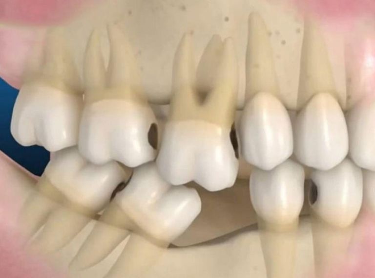 Mất răng hàm khiến việc nhai nghiền thức ăn gặp nhiều khó khăn