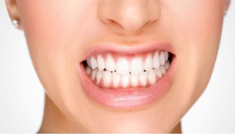 Nghiến răng làm tăng nguy cơ mẻ răng cao hơn