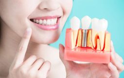 Đối với người bị mất răng, cấy ghép Implant là phương pháp hiện đại nhất