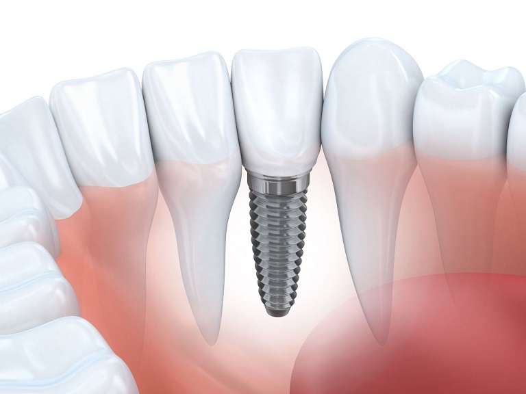 Trồng răng Implant là một phương pháp giúp người bệnh phục hình răng bị mất