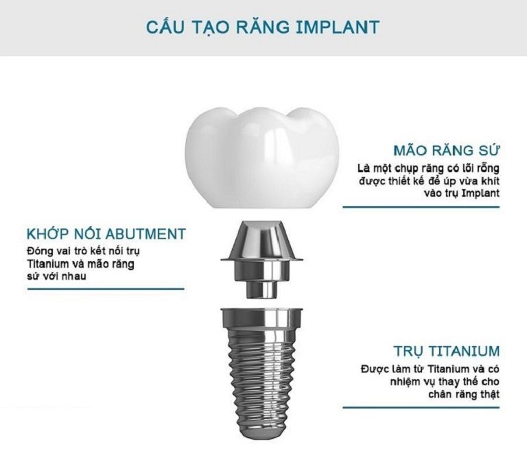 Một răng Implant sẽ có cấu tạo gồm có 3 bộ phận chính