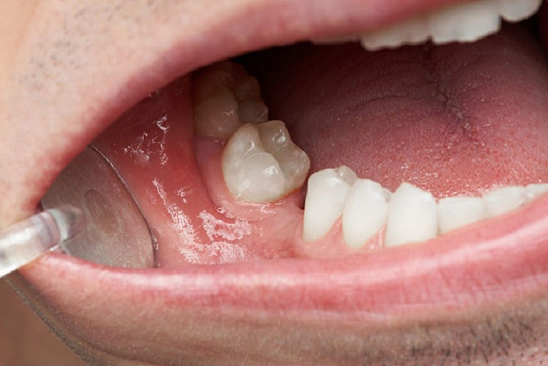 Cấy ghép Implant phục hình cho người mất 1 răng, nhiều răng hoặc toàn hàm