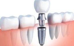 Trồng răng Implant là phương pháp đòi hỏi kỹ thuật cao