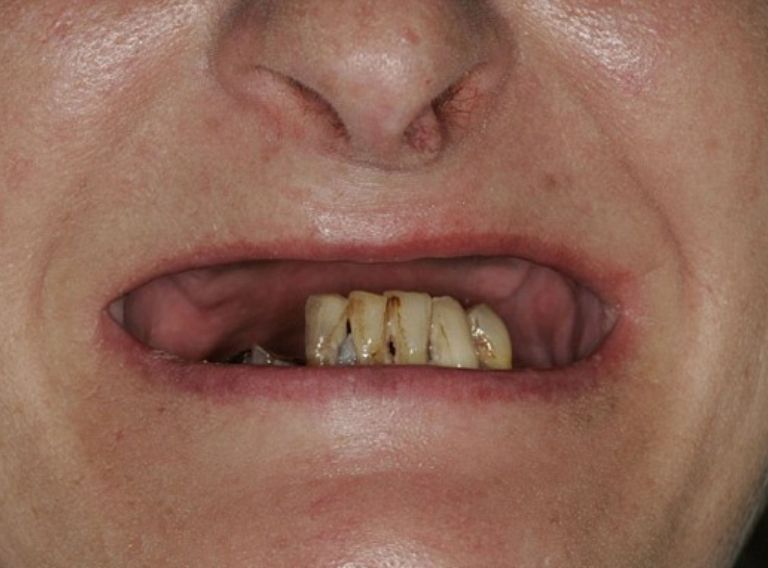Mất răng nguyên hàm là hiện tượng toàn bộ các răng ở trên cung hàm đều bị mất