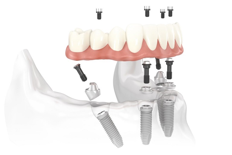 Cấy ghép Implant được coi là phương pháp trồng răng nguyên hàm tối ưu nhất