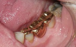 Răng vàng thực chất là loại răng được chế tác từ hợp kim quý hiếm