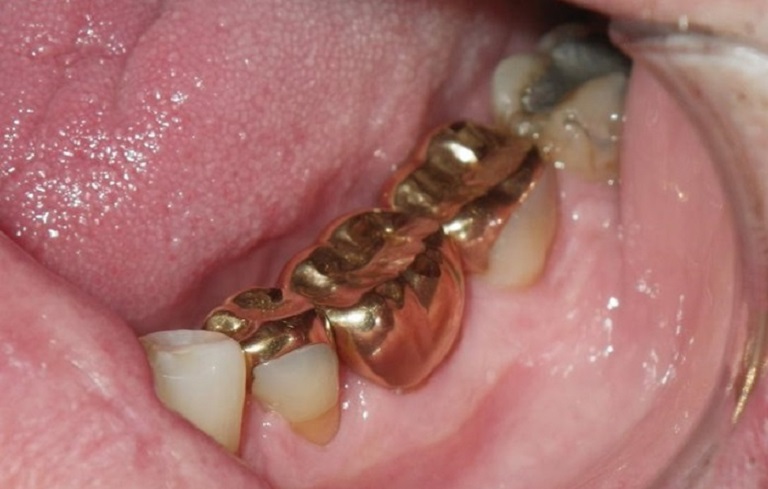 Răng vàng thực chất là loại răng được chế tác từ hợp kim quý hiếm
