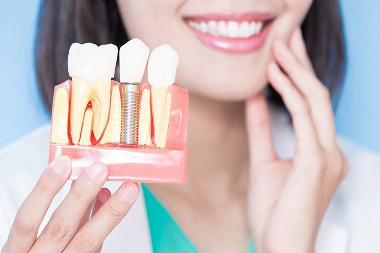 Cấy ghép Implant được biết đến là kỹ thuật trồng răng khểnh hiện đại