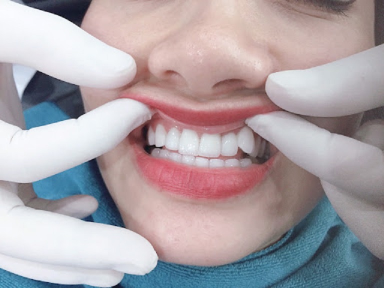 Trồng răng khểnh bằng Composite sẽ không hề gây ra đau đớn cho người thực hiện