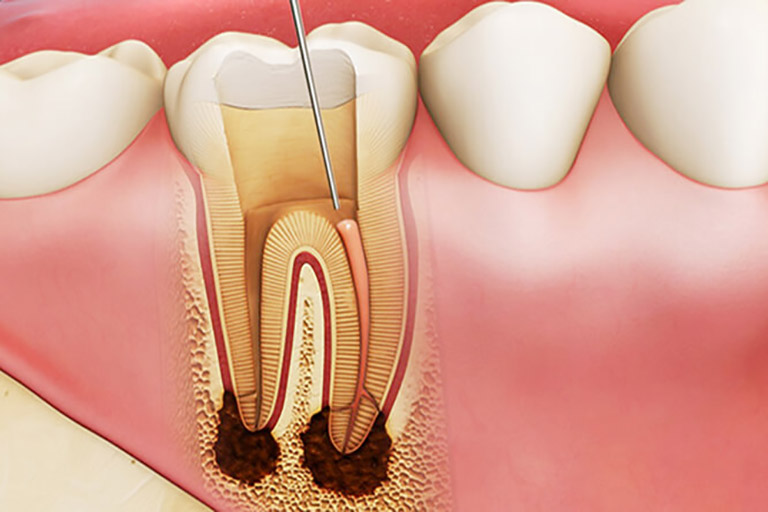 Tình trạng bệnh viêm tủy răng hồi phục xảy ra khi mức độ viêm nhẹ