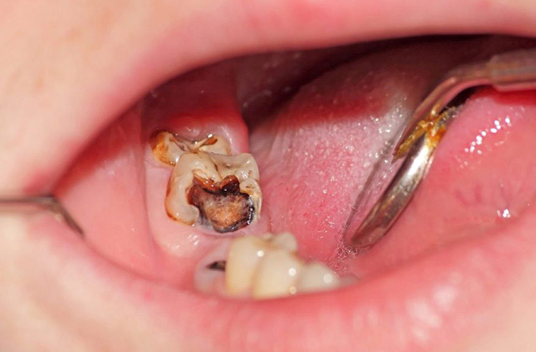 Viêm tủy răng không hồi phục xuất hiện khi hiện tượng viêm nhiễm trở nặng