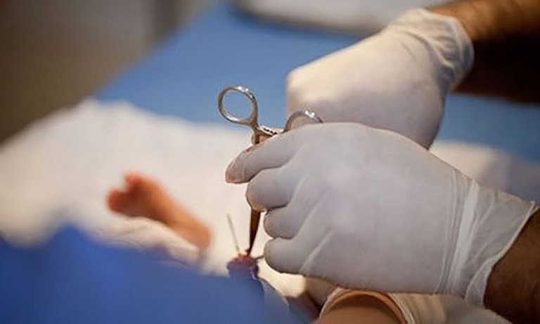 Thực hiện cắt bao quy đầu không đúng kỹ thuật là một trong những nguyên nhân dẫn đến xuất tinh sớm