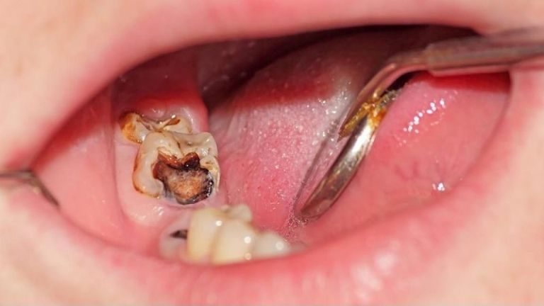 Sâu răng có thể là nguyên nhân gây đau nhức răng khôn