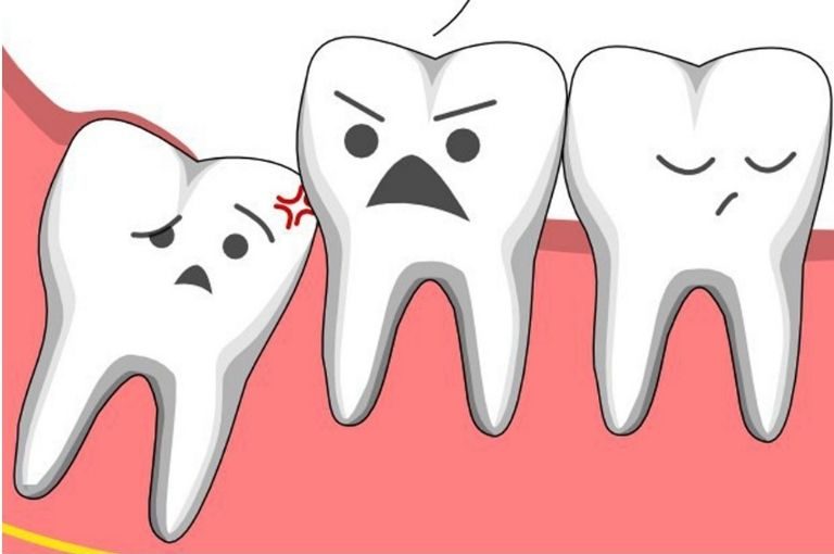 Triệu chứng đau răng khôn nặng hay nhẹ còn phụ thuộc vào từng đối tượng