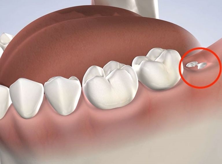 Người bệnh nên chú ý vệ sinh trong quá trình răng khôn mọc