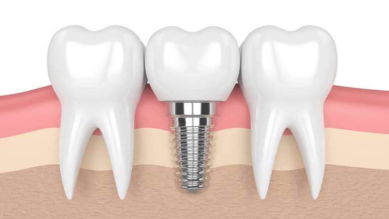 Trồng răng sứ cố định còn được gọi là cấy ghép Implant