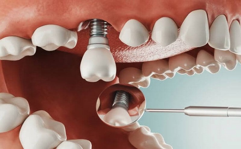 Cấy ghép Implant phục hình được cho trường hợp bệnh nhân bị mất răng lâu năm
