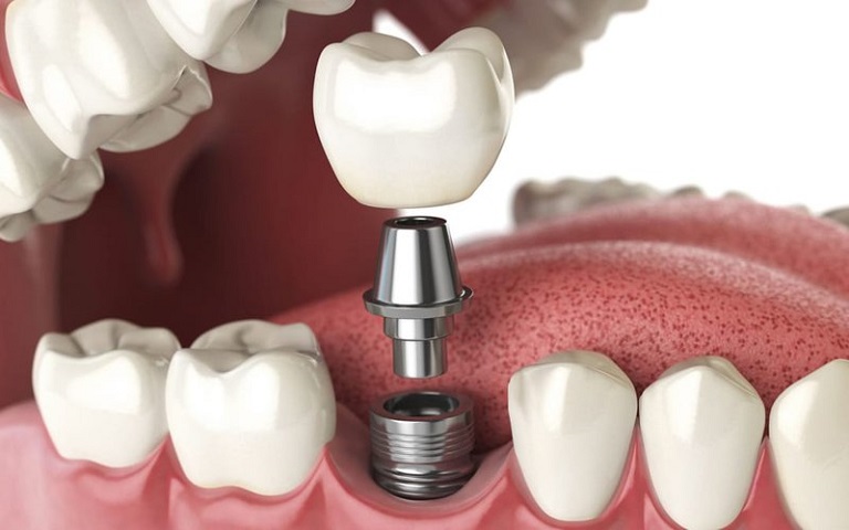 Trồng răng sứ trên Implant giúp người bị mất răng cải thiện khả năng ăn nhai toàn diện
