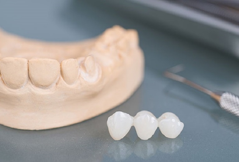 Trồng răng sứ là một trong những phương pháp thẩm mỹ nha khoa hiện đại