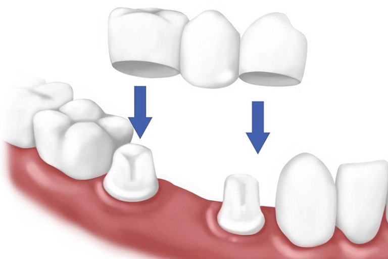 Làm cầu răng sứ sẽ có giá rẻ hơn nhiều so với cấy ghép Implant