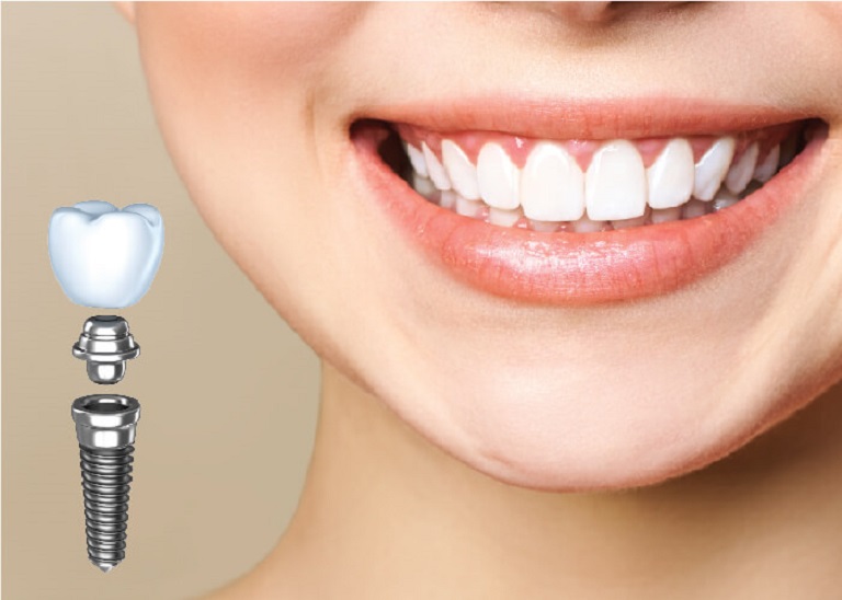 Răng Implant cấu tạo gồm 3 phần cơ bản là phần trụ, khớp nối và mão sứ