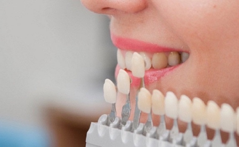 Quy trình thực hiện trồng răng sứ diễn ra vô cùng đơn giản