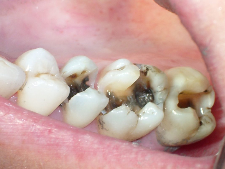 Răng bị sâu, viêm có thể chỉ định điều trị tủy