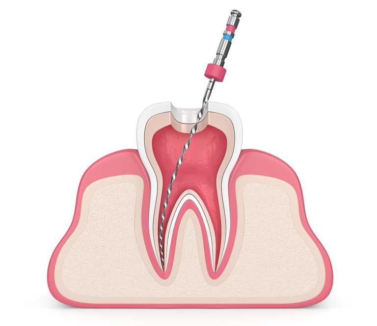 Tuổi thọ của răng sau khi lấy tủy sẽ không bằng răng bình thường