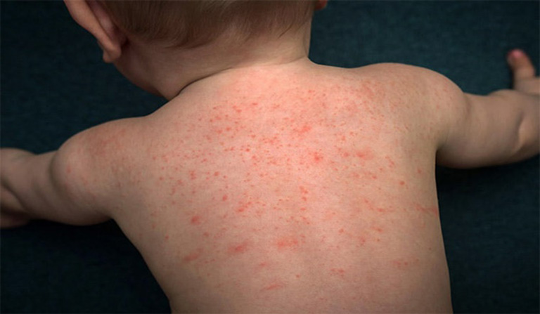Bệnh chốc lở có thể lây lan đến các vùng da khác trên cơ thể và làm xuất hiện các nốt mẩn đỏ