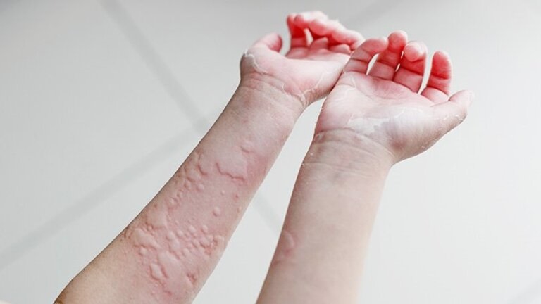 Chà lá kinh giới lên da chữa mề đay cần thực hiện nhẹ nhàng để tránh làm tổn thương da