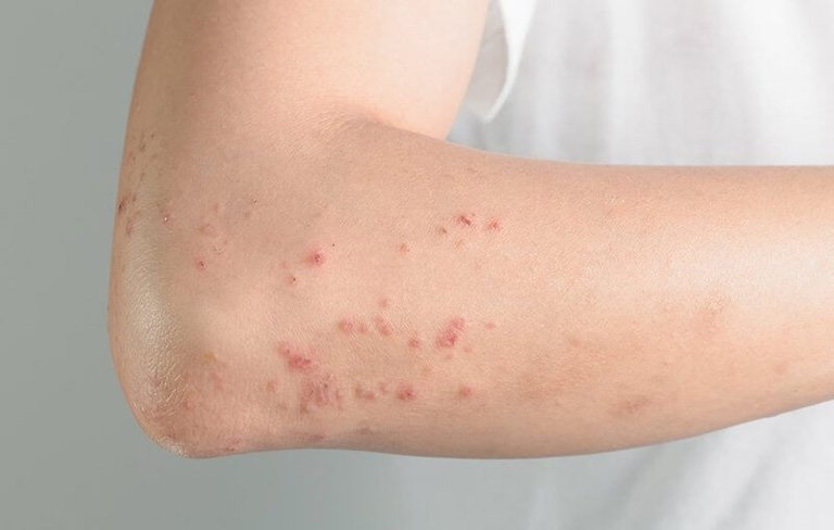 Hiện tượng da nổi mẩn đỏ ngứa như muỗi đốt do nhiều nguyên nhân khác nhau