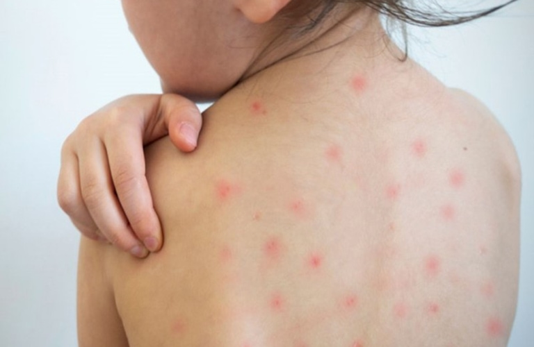 Nổi mẩn đỏ khắp người trẻ sau sốt không quá nguy hiểm