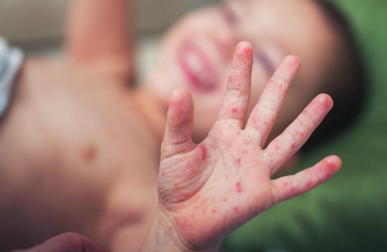 Trẻ bị nổi mẩn đỏ khắp người sau sốt do chân tay miệng dễ để lại sẹo nếu không điều trị đúng cách