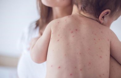 Bé nổi mẩn đỏ khắp người sau sốt có nguy hiểm không?