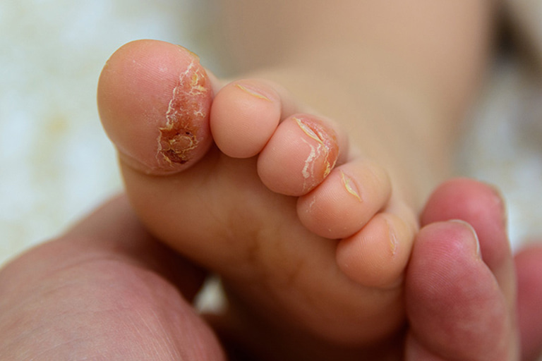 Triệu chứng dễ bắt gặp nhất của trẻ khi mắc bệnh là da bong tróc, đặc biệt ở chân hoặc tay