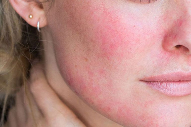 Da mặt bị nổi mẩn đỏ không ngứa xuất hiện ở mọi đối tượng và do khá nhiều nguyên nhân