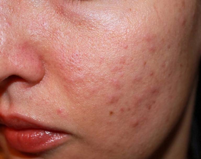 Tình trạng dị ứng cũng làm xuất hiện tình trạng nổi mẩn đỏ không ngứa ở mặt