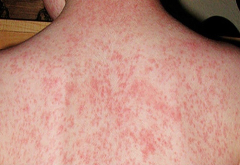Sốt phát ban có biểu hiện là xuất hiện các đốm nhỏ trên da đi kèm nóng người