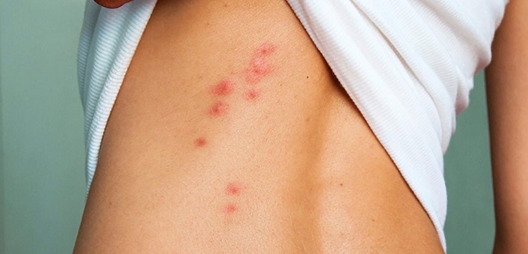 Viêm da tiếp xúc làm xuất hiện các vết nổi mẩn đỏ không ngứa, xảy ra khi cơ thể tiếp xúc với dị nguyên