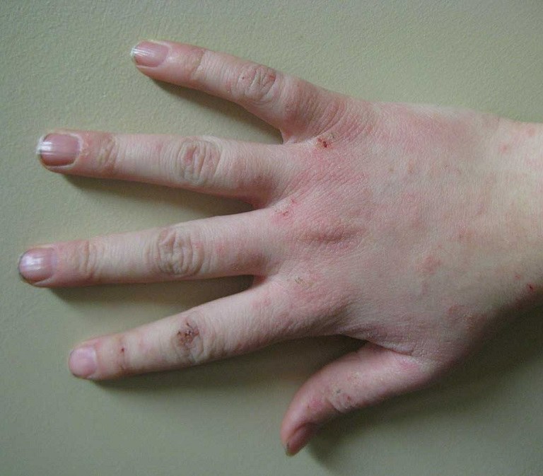 Da tay nổi mẩn đỏ là hiện tượng thường gặp ở nhiều lứa tuổi