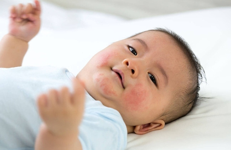 Nổi mẩn đỏ ở trẻ sơ sinh do ban nhiễm độc xuất hiện khoảng 2-3 ngày sau sinh
