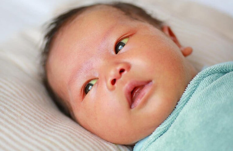 Viêm da tiết bã nhờn là một trong những nguyên nhân khiến trẻ sơ sinh bị nổi mẩn đỏ