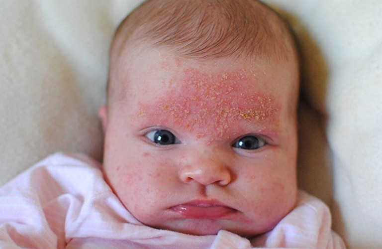 Bé sơ sinh bị nổi mẩn đỏ có thể là dấu hiệu của bệnh chàm sữa