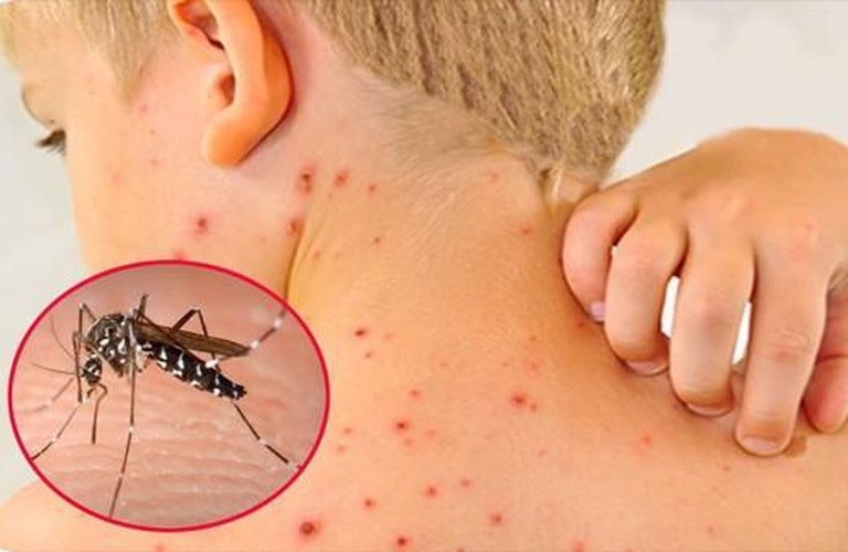 Trẻ bị nổi mẩn đỏ ngứa có thể xuất hiện trong hoặc sau khi bị sốt xuất huyết.